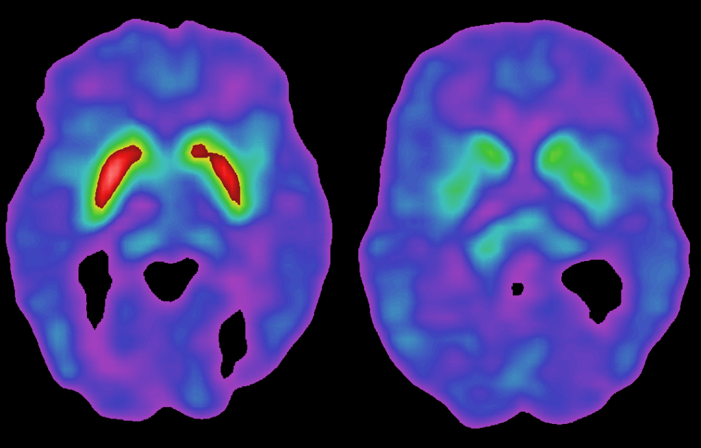 parkinson-brain-scan