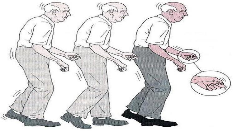 Parkinsons-walk