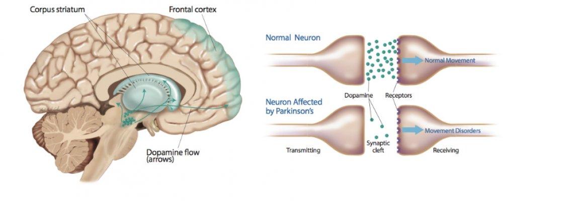 What Causes Parkinson S Disease Dopamine